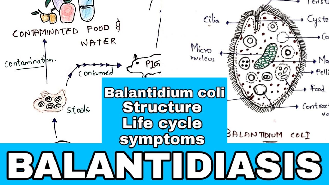 111-balantidiasis