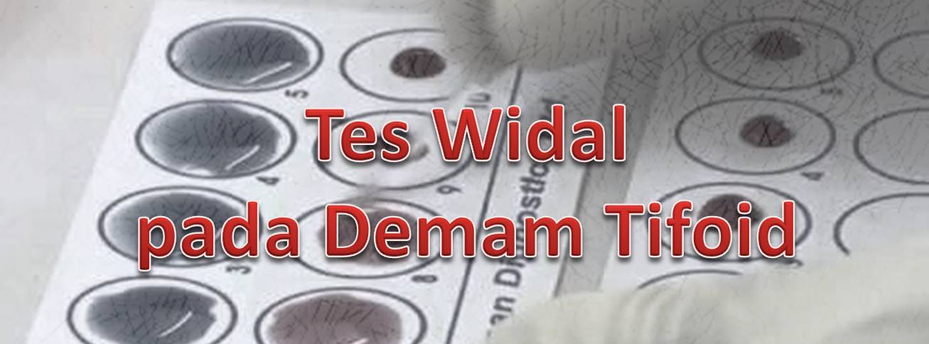 141-pemeriksaan-widal