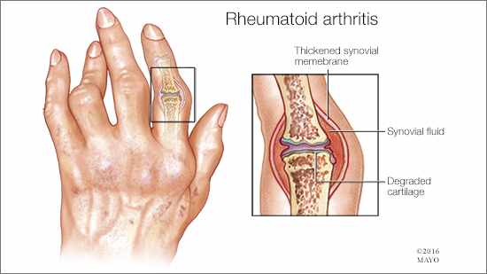 144-rheumatoid-arthritis