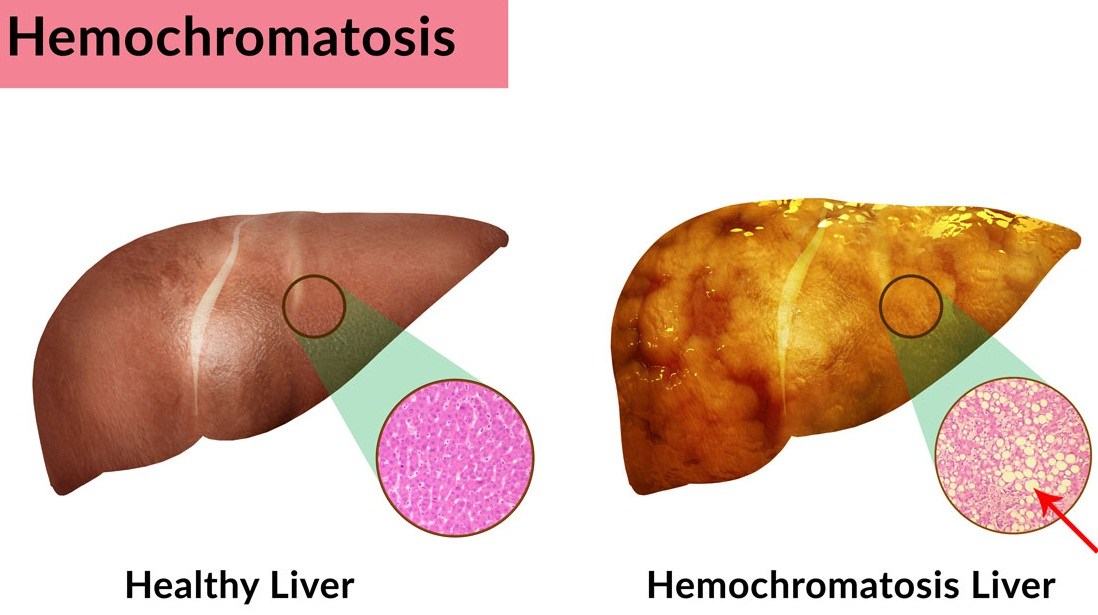 153-hemokromatosis