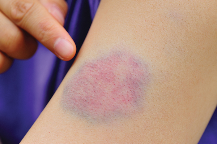 170-hematoma-gejala-penyebab-jenis-dan-komplikasi