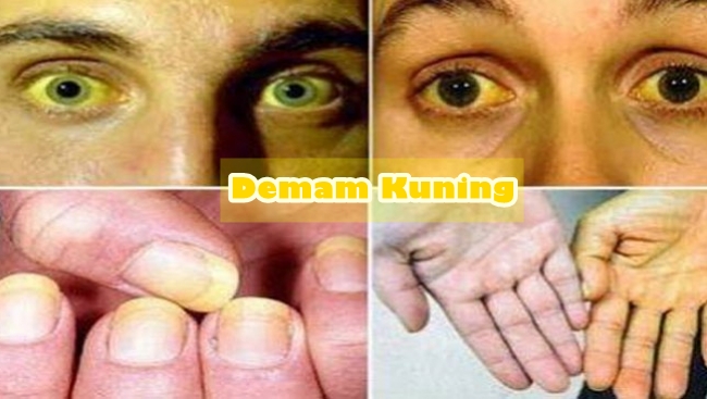 172-yellow-fever-atau-demam-kuning