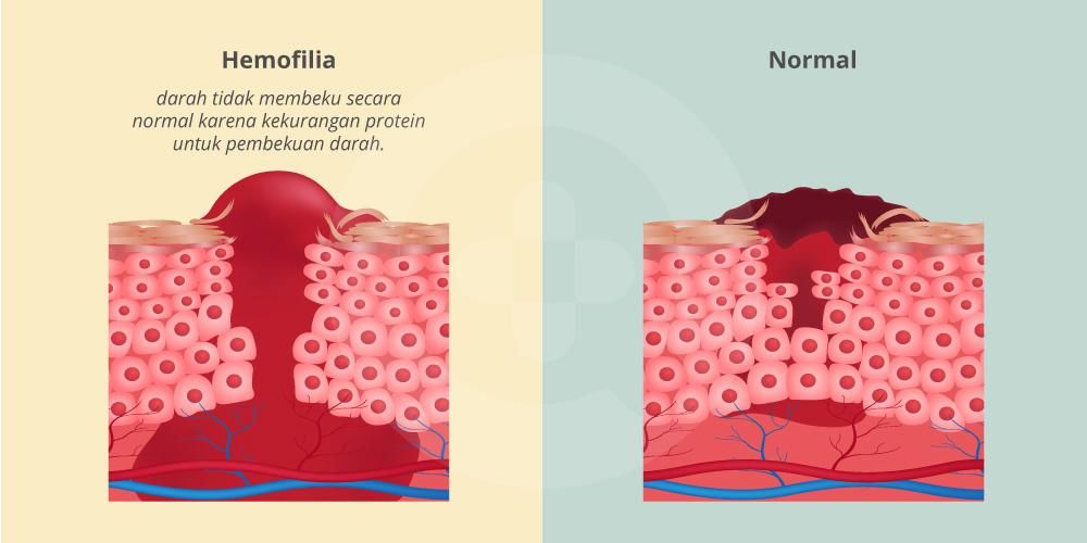 225-hemophilia