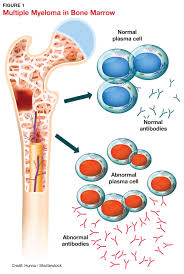 228-multiple-myeloma