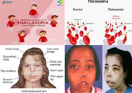 237-thalasemia